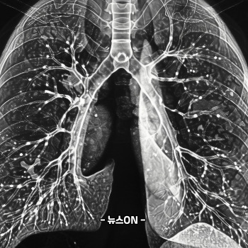 이문수 사망 폐암