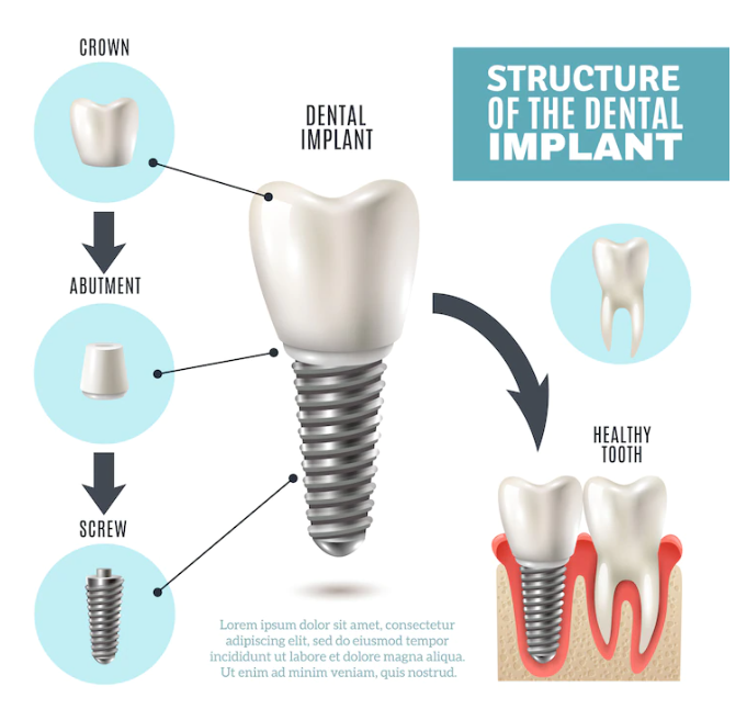 임플란트의 구성요소