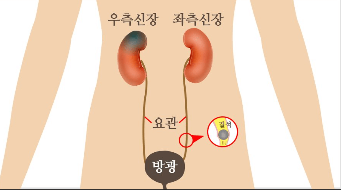 요로결석-증상과-원인