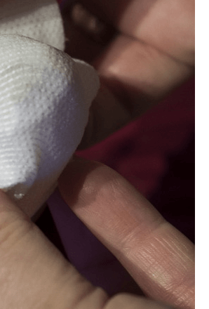 손가락마디통증