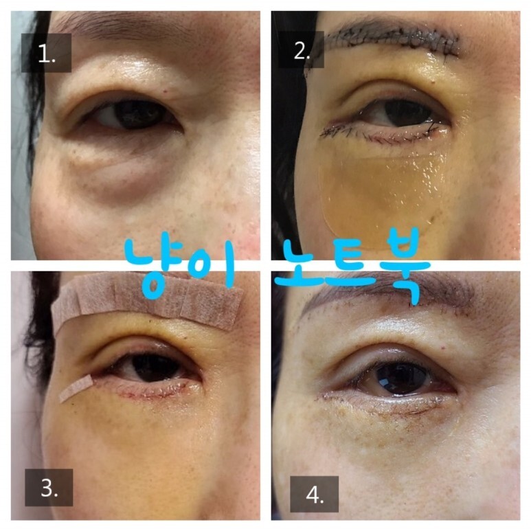 하안검 수술 후기