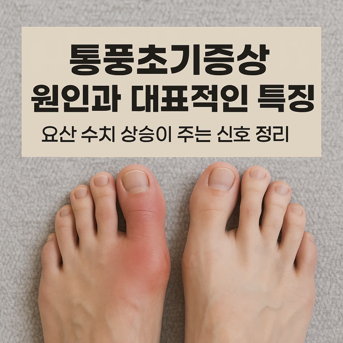 통풍초기증상 원인과 대표적인 특징, 요산 수치 상승이 주는 신호 정리