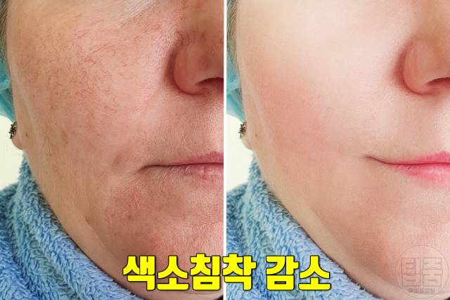 얼굴 건조 각질 세라마이드 효능 색소침착 검버섯