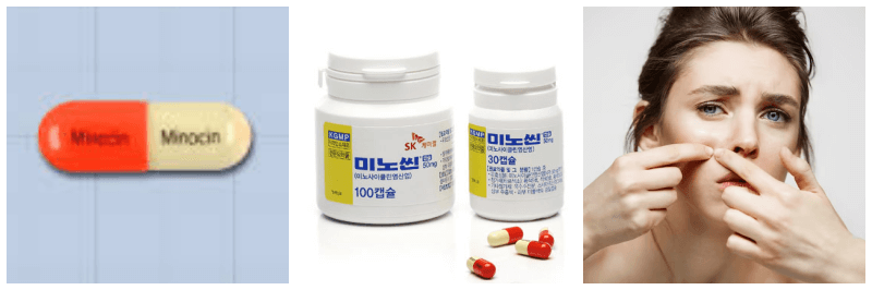 미노씬캡슐, 여드름 사진