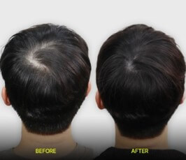 머리카락-다시-나는-꿈