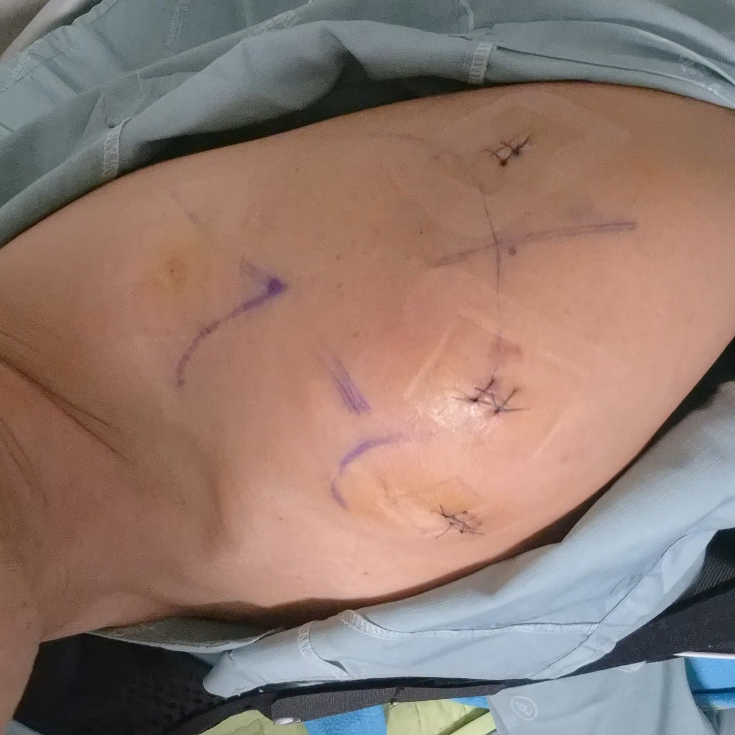 어깨 와순파열 봉합수술 후 mri사진 물리치료 기록