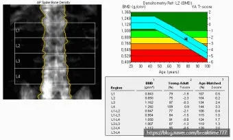 골밀도 검사 수치 골밀도 높이는 방법 간단 정리_6
