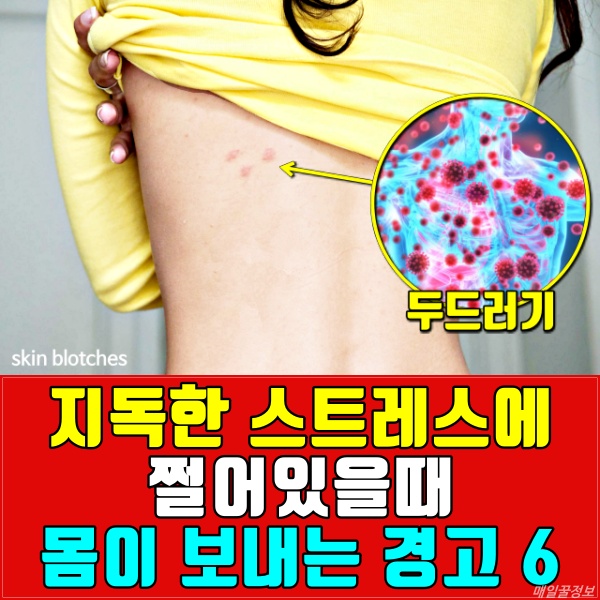 심한 스트레스 증상, 두드러기, 피부, 건강 팁줌 매일꿀정보