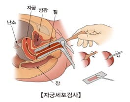 자궁경부암&amp;#44; 자궁경부암 증상&amp;#44; 자궁경부암 예방접종&amp;#44; 자궁경부암 예방접종 무료대상&amp;#44; 자궁경부암 검사&amp;#44; 자궁경부암 원인&amp;#44; 자궁경부암 검사방법&amp;#44; 자궁경부암 예방접종 가격&amp;#44; 자궁경부암 검사 성경험 없는 사람&amp;#44; 자궁경부암 검사비용&amp;#44; 가다실 9가&amp;#44; 서바릭스&amp;#44; 가다실 4가