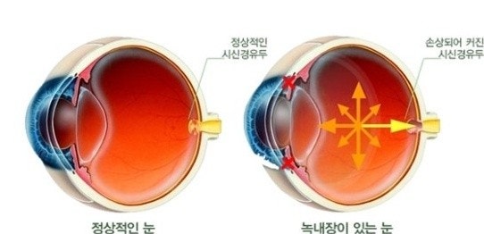 정상인안구와 녹내장이 있는 안구의 그림