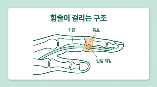 방아쇠 수지 힘줄 구조 설명