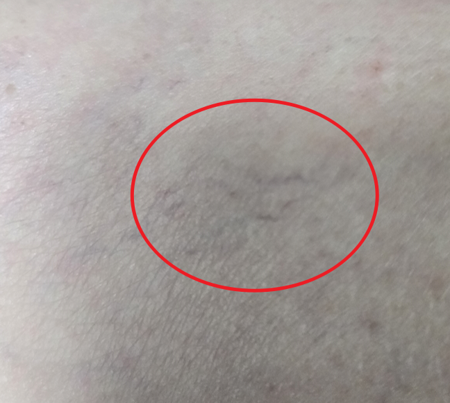 허벅지에 보라색 핏줄이 생기는 이유는 무엇일까?