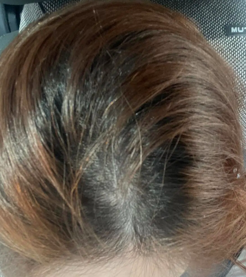 그로우턴 후기 효과 부작용 총정리