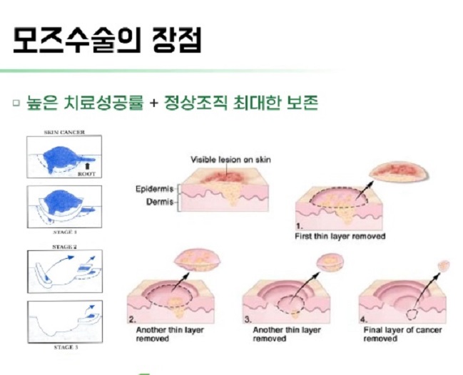 모즈수술장점-김훈수교수