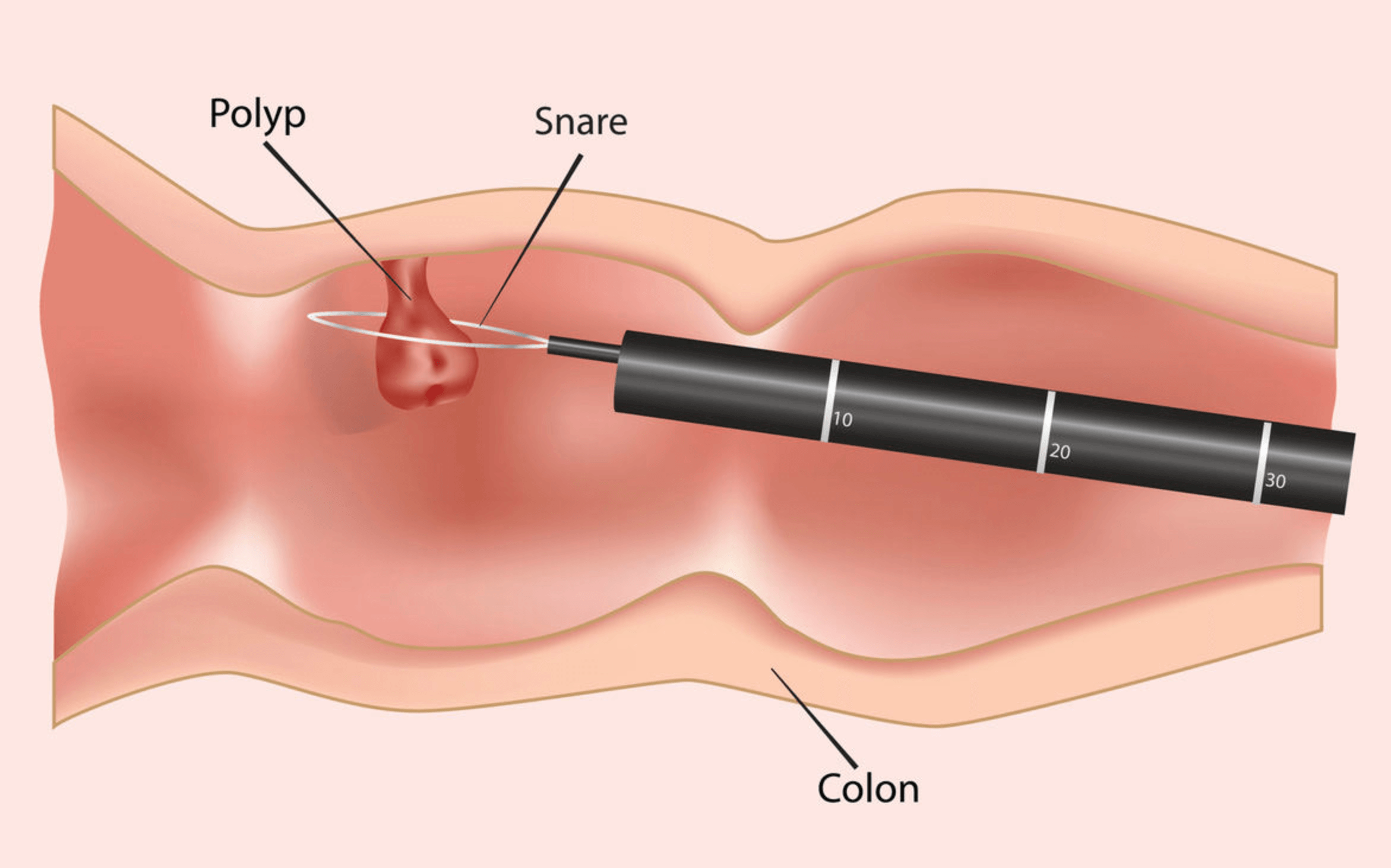 대장내시경-용종-제거
