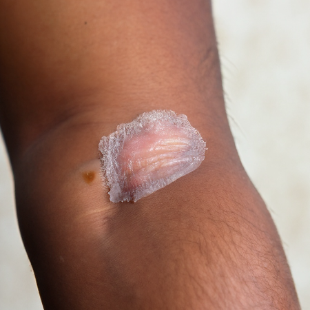 화상물집-치료방법