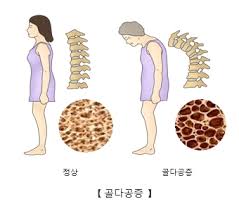  골밀도 검사수치