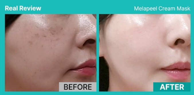 멜라필-크림-마스크-효과