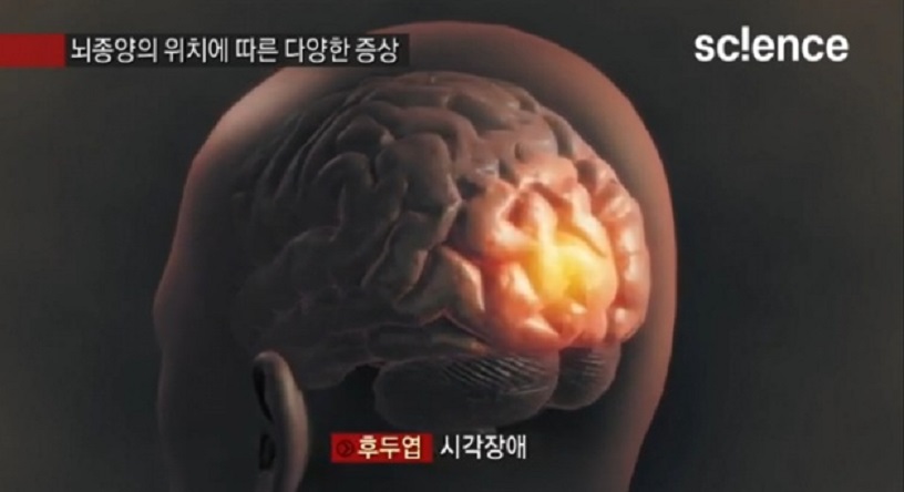 뇌종양위치에따른증상