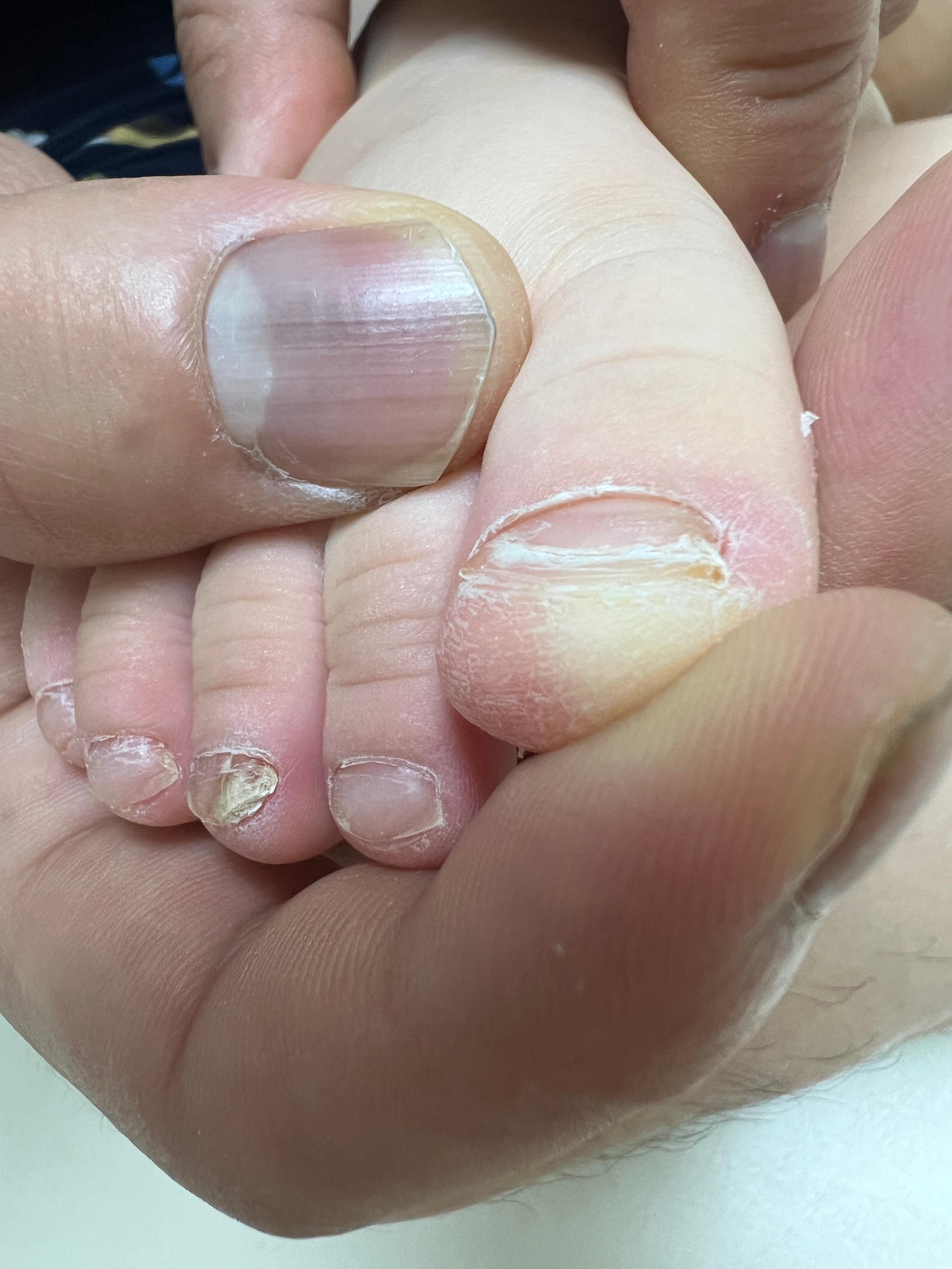 아이 발톱무좀 사진