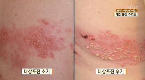 대상포진 초기 후기 증상