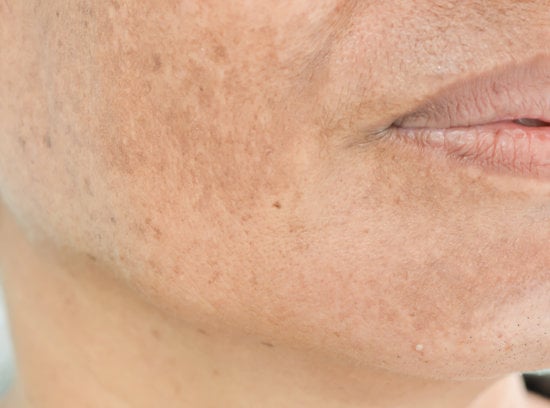 기미(Melasma): 원인, 병리기전 및 치료 접근법