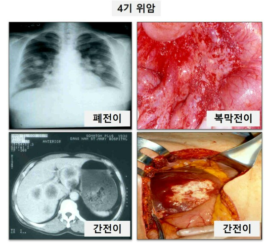 4기위암