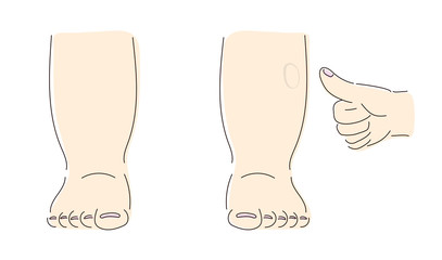 부종 원인 질환 치료 부기