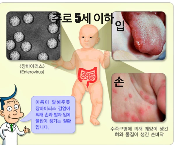 수족구병은 어떤 병인지 보여주는 이미지. 가운데에는 아이가 있고 왼쪽에는 장바이러스, 오른쪽에는 입과 손에 생긴 물집이 보인다.