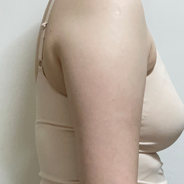 수술하기 전 옆 모습.