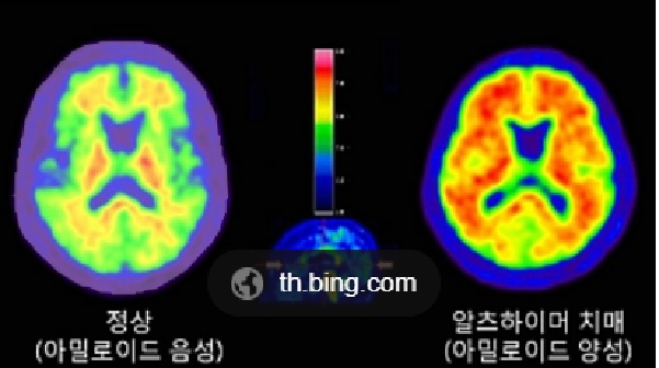 아밀로이드 PET-CT 영상