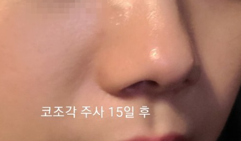 코조각주사 후기