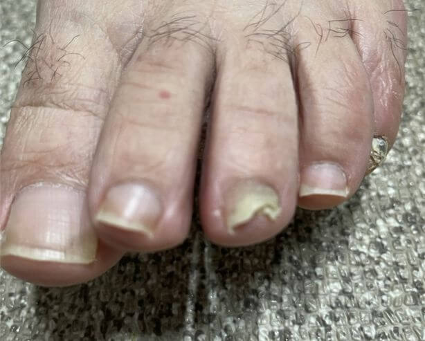 발톱 무좀 치료 및 없애는 확실한 방법