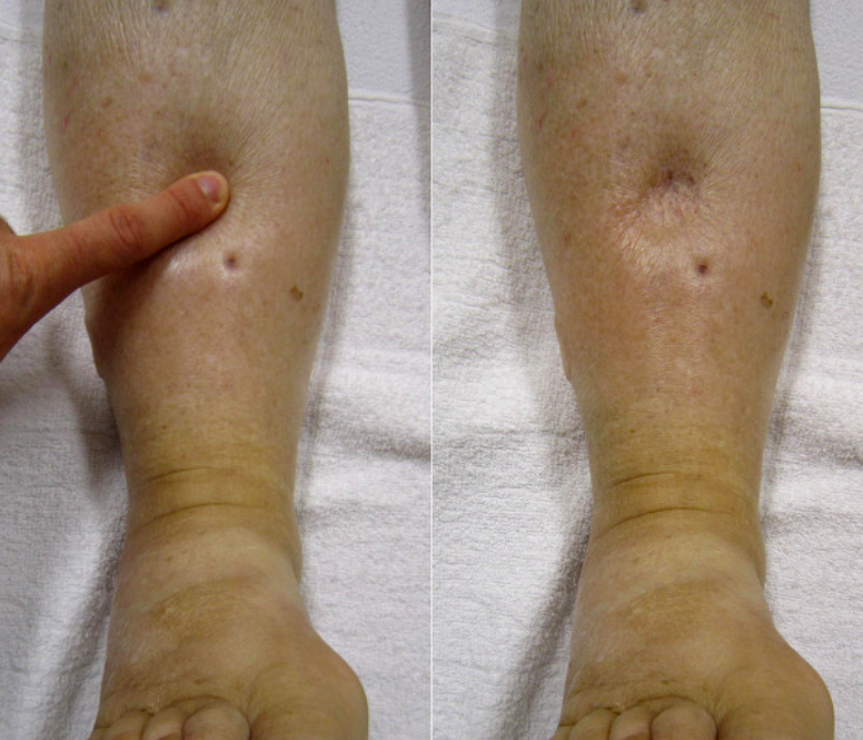 통풍 증상 - 부종