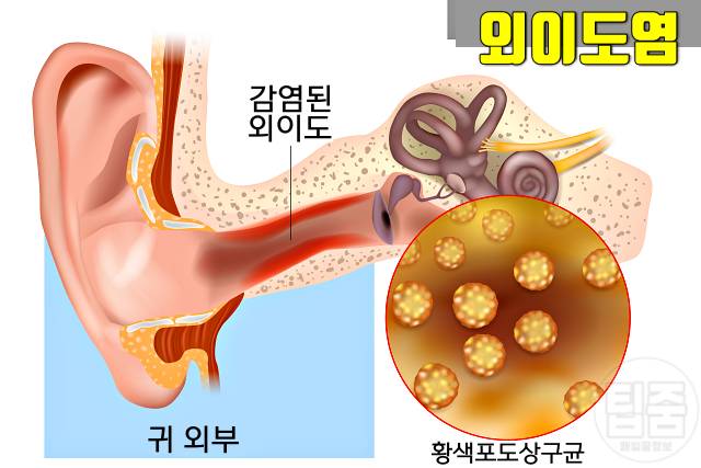 뇌경색 여름철 질병 여름질병 외이도염