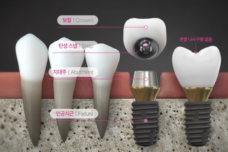네오바이오텍 똑딱임플란트 구조&amp;#44; 체결방식