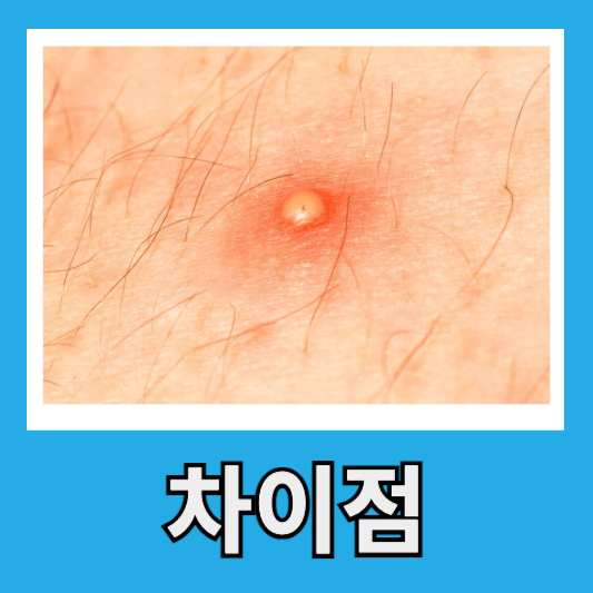 단순 종기 차이점