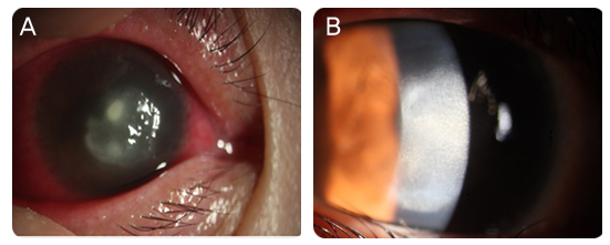 콘택트렌즈-증상-설명하는-사진