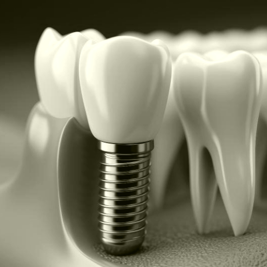 임플란트 시술 비용과 보험 적용 범위2