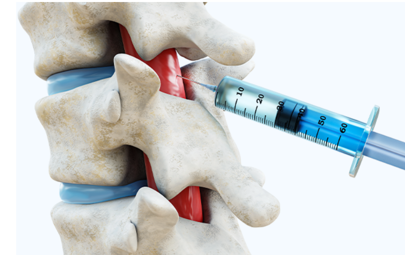 신경차단술 이미지