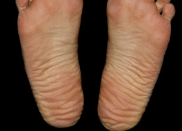 맨발 걷기 부작용