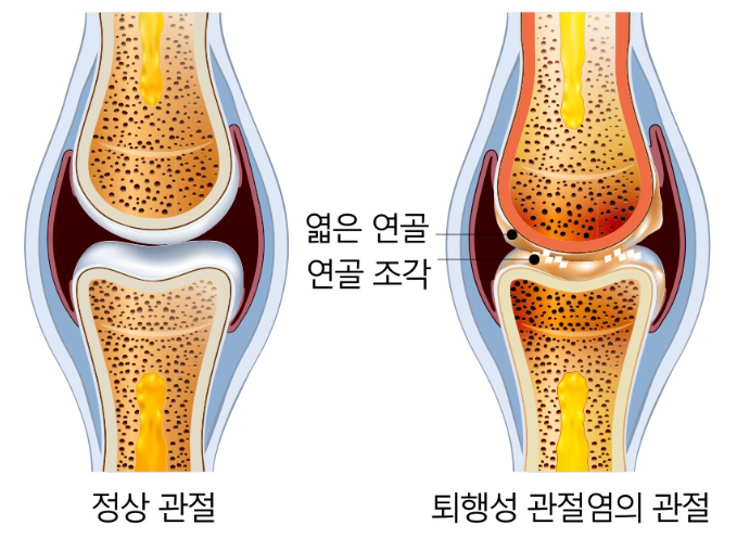 관절염의종류