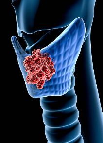 갑상선암 증상, 수술후 회복기간, 수술후 좋은음식 총정리 (2024ver)