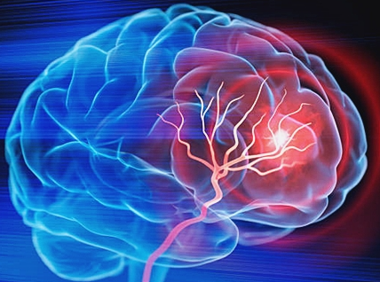 뇌졸중-징후-빠르게 확인하는 법-fast