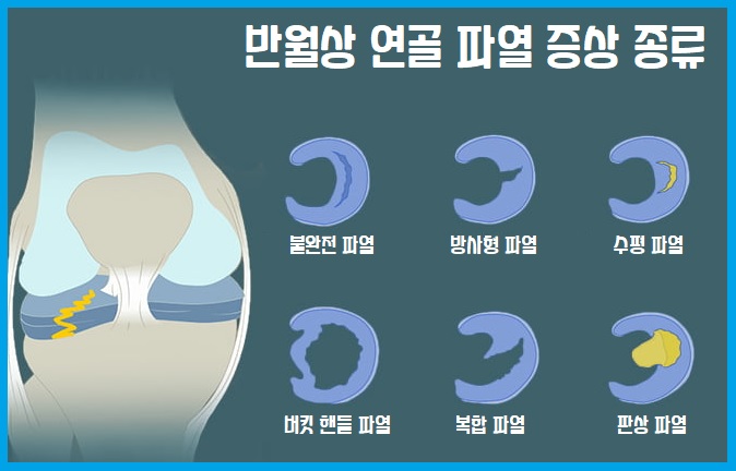 반월상 연골 파열 증상 종류