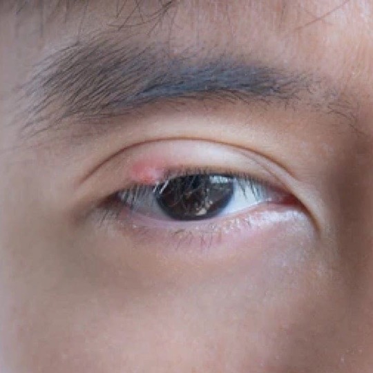 눈꺼풀에 염증이 생긴 사진