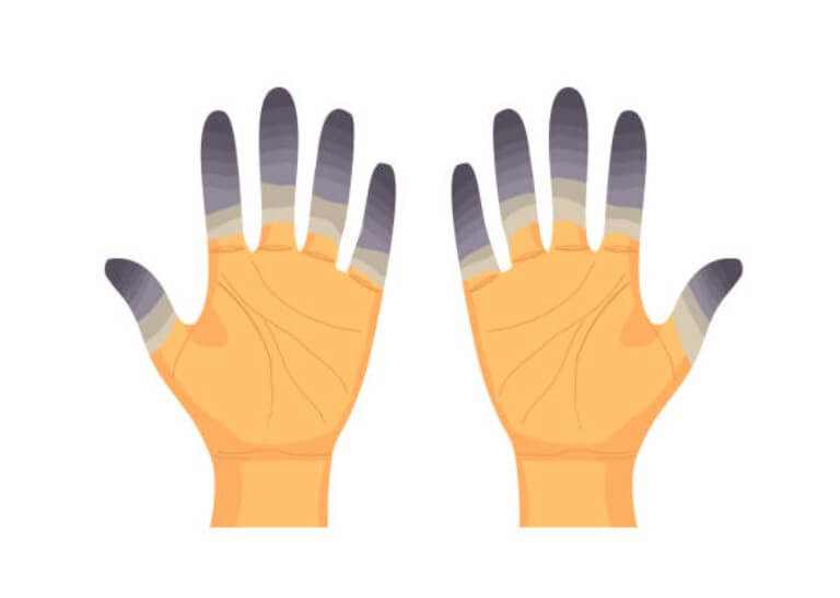 동상원인-갑상선기능저하증 동상원인-당뇨병 동상원인-영양실조