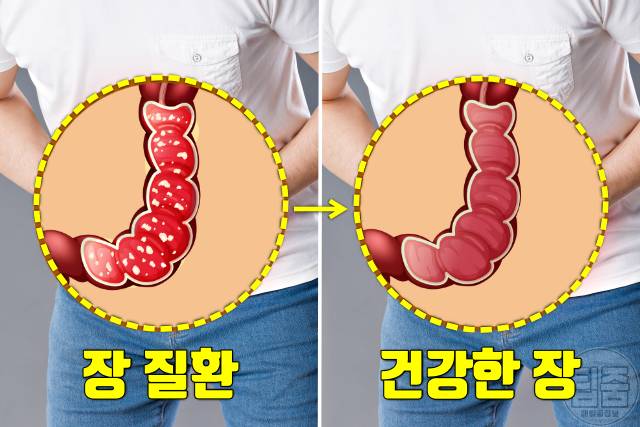 오이 효능 대장암 오이 매일 먹으면