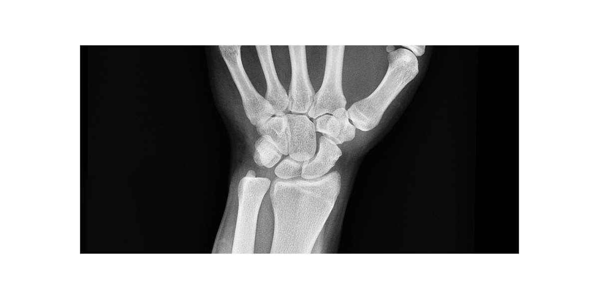 손목터널증후군 증상