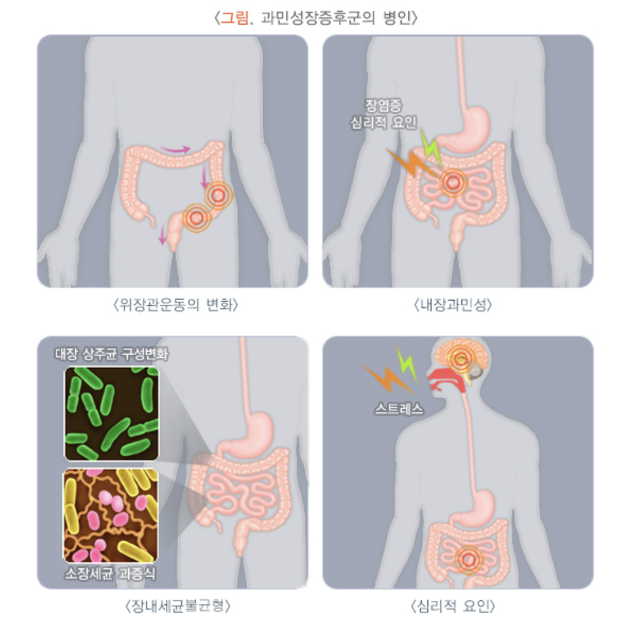 과민성대장증후군 원인